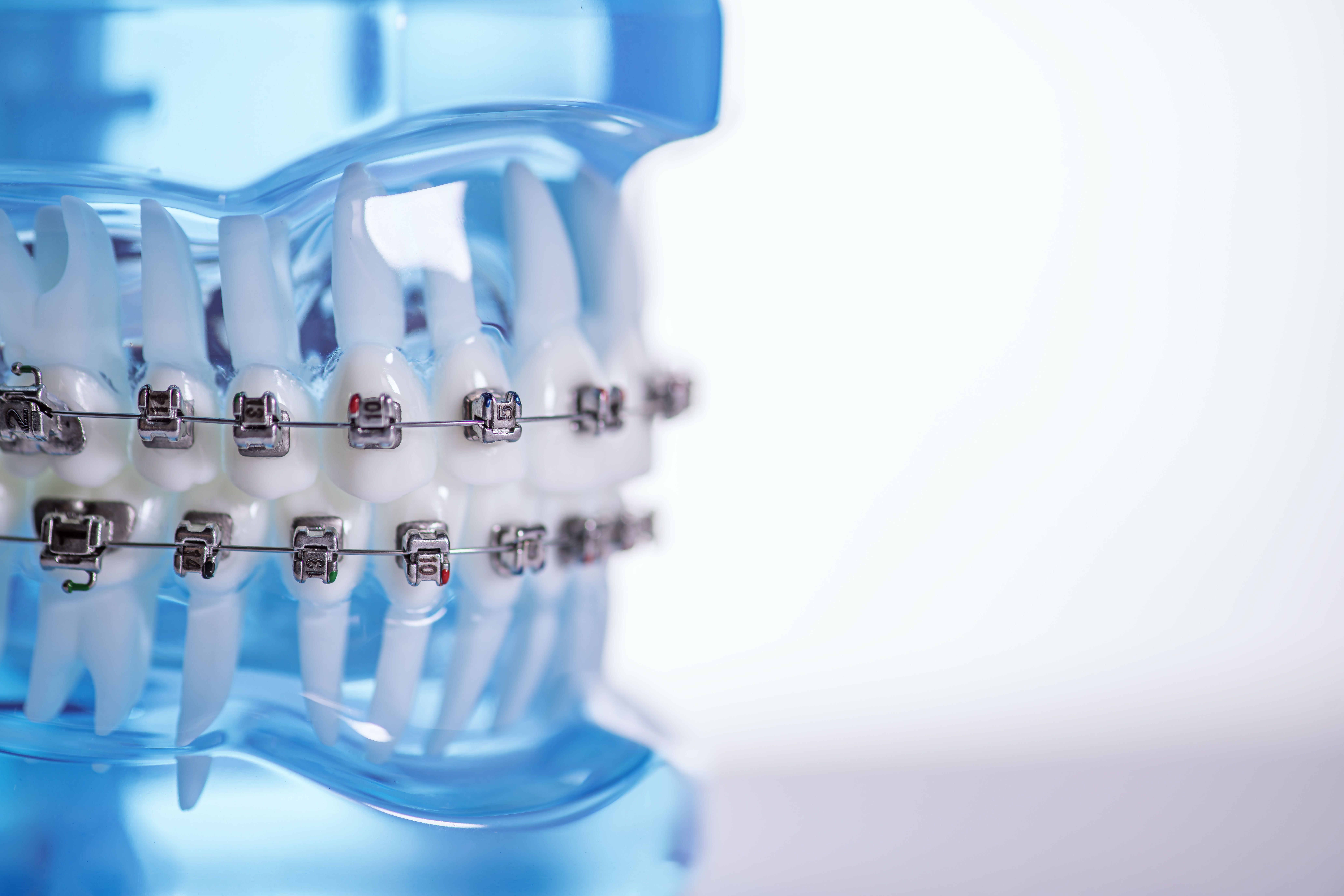 KLOwen Orthodontics Unveils Revolutionary Custom Metal SL Solution